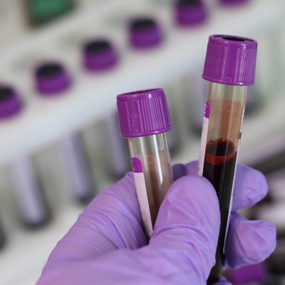 Two samples of blood being held in a hand with a purple glove.